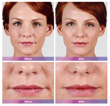 Juvederm Before & After Boston, MA