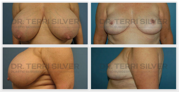 Breast Reduction Before & After Boston, MA