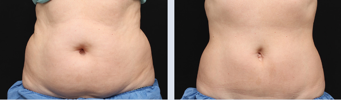 CoolSculpting Before & After Boston, MA