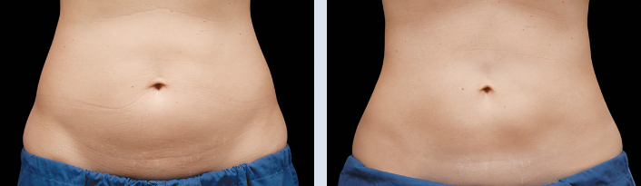 CoolSculpting Before & After Boston, MA