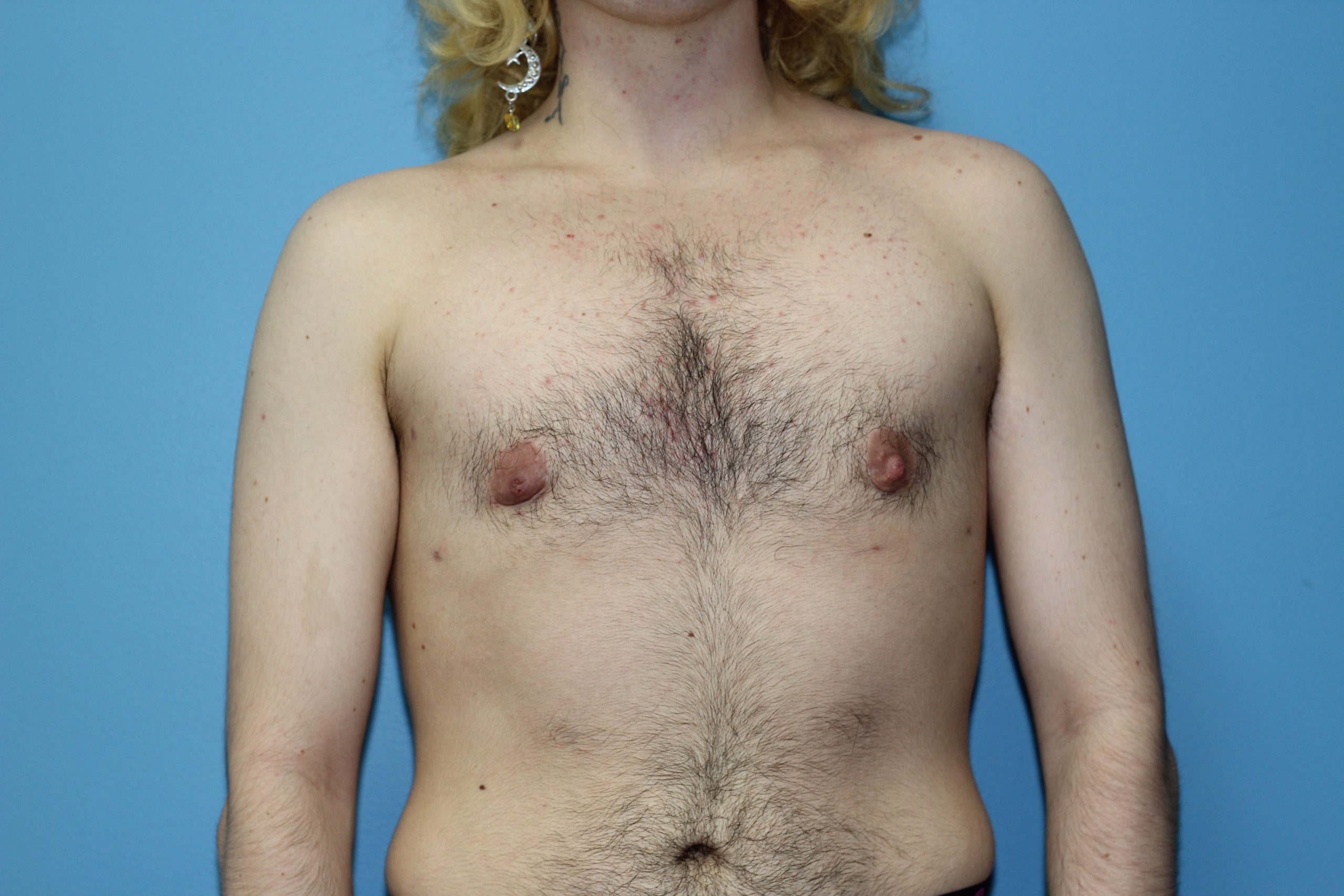 subcutaneous mastectomy Boston