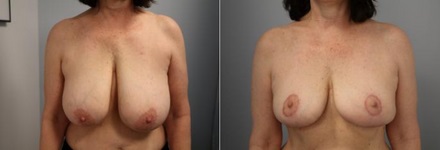 Boston Breast Reduction